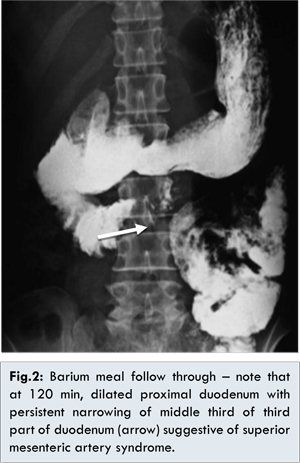 right sided ligament of treitz malrotation